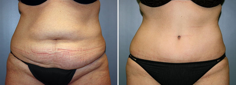 Tummy Tuck Patient 21