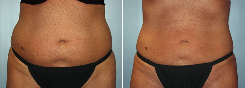 CoolSculpting® Patient 10