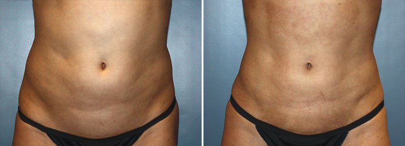 CoolSculpting® Patient 11