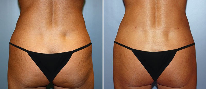 Liposuction Patient 6