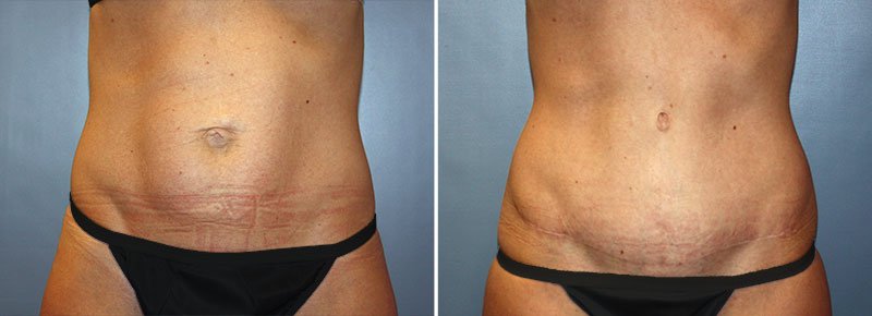 Tummy Tuck Patient 20