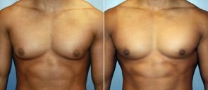 Male Breast Reduction (Gynecomastia) Patient 4