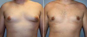 Male Breast Reduction (Gynecomastia) Patient 5