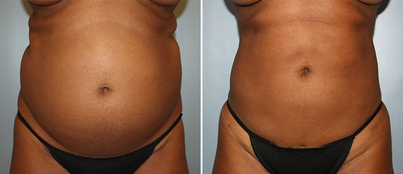 Liposuction Patient 7