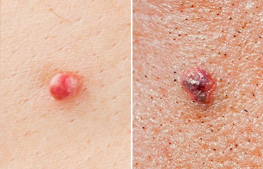 Cancer Bumps On Skin