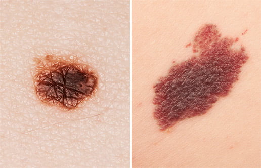 Melanoma Example