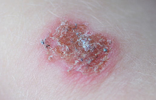 Squamous Cell Carcinoma