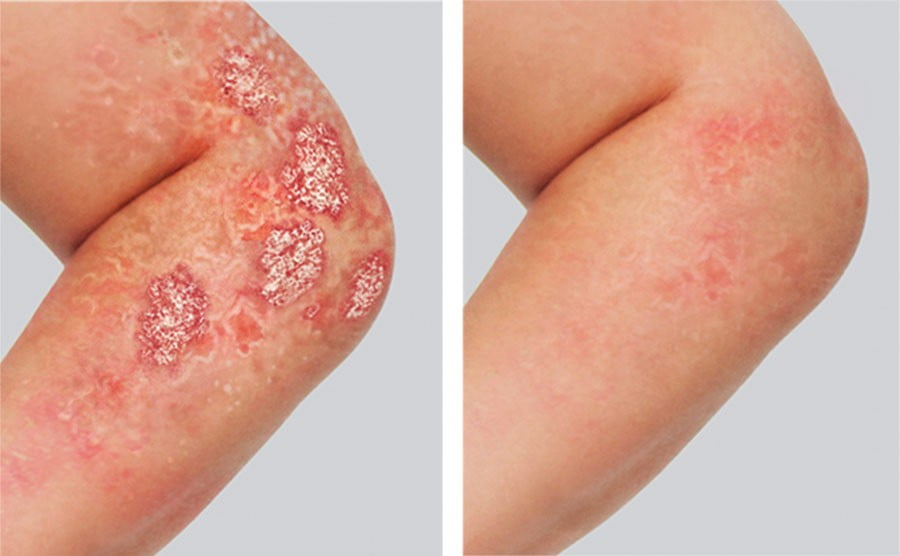 Before and after using Humira to treat plaque psoriasis