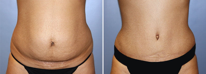 Tummy Tuck Patient 22