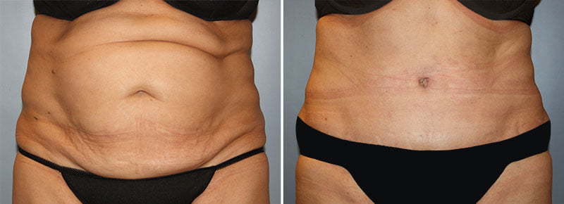 Tummy Tuck Patient 23