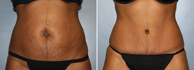 Tummy Tuck Patient 24