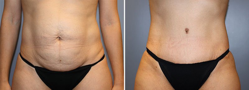 Tummy Tuck Patient 25