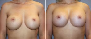 Breast Implant Revision Patient 6