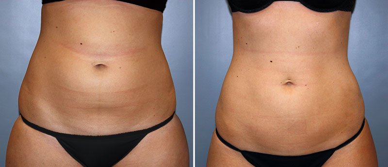 Liposuction Patient 8