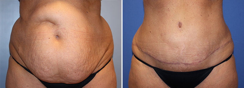 Tummy Tuck with Liposuction Patient 26