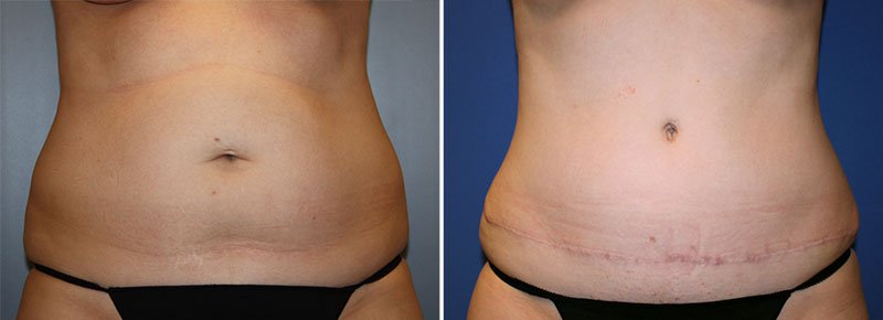 Tummy Tuck Patient 27