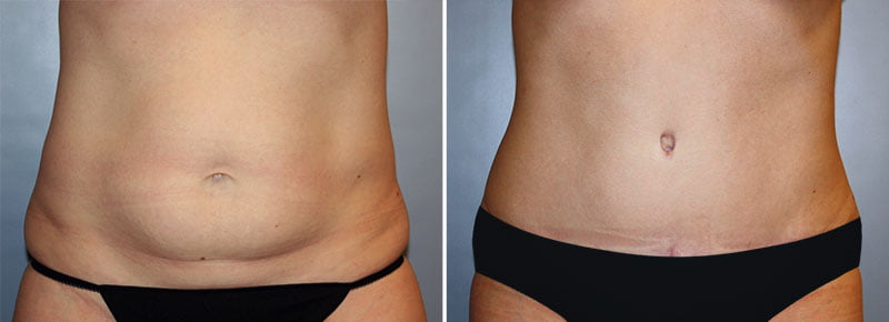 Tummy Tuck Patient 28