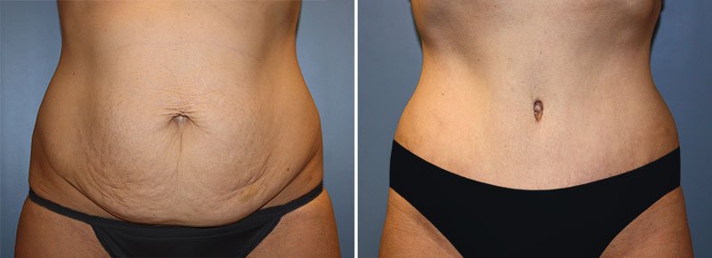 Tummy Tuck Patient 30