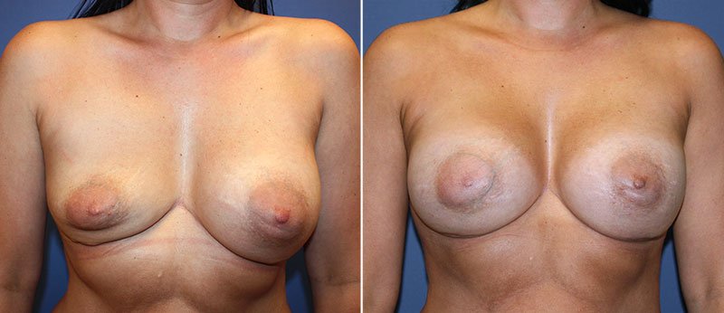 Breast Implant Revision Patient 8