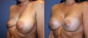 breast-revision-15790b-berks