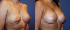 breast-revision-15790b-left-berks