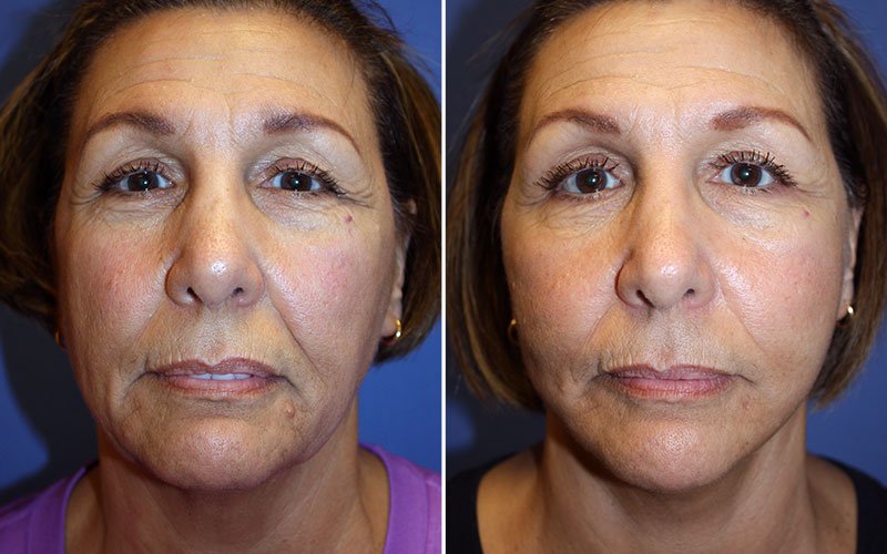 Facelift Patient 3