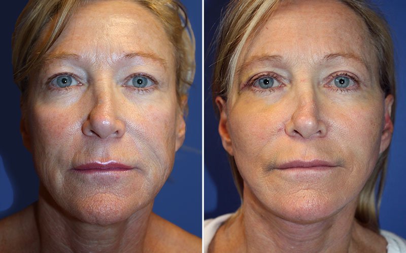 Facelift Patient 4