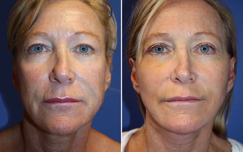 Facelift Patient 4