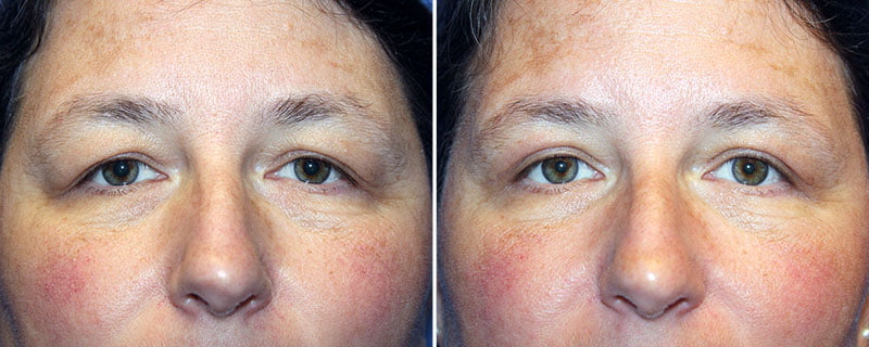 Eyelid Rejuvenation Patient 9