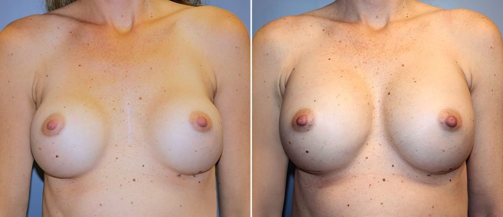 Breast Implant Revision Patient 9