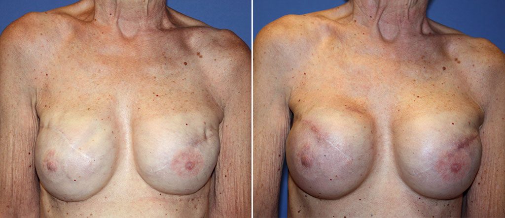 Breast Reconstruction Patient 1