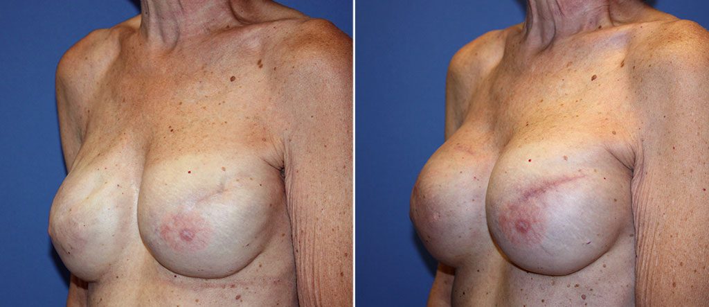 breast-reconstruction-17618b-berks