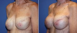 breast-reconstruction-17618b-berks