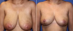 Breast Reduction Patient 20