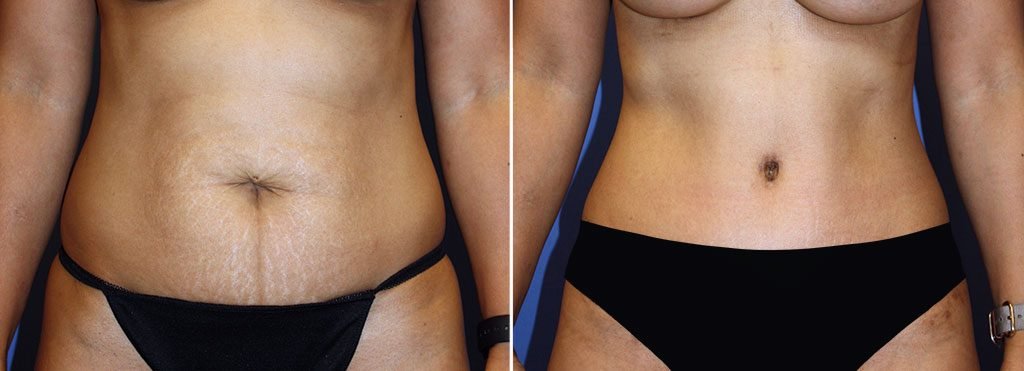 Tummy Tuck Patient 31