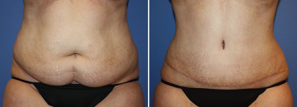 Tummy Tuck Patient 32