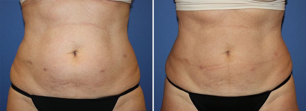 CoolSculpting® Patient 14