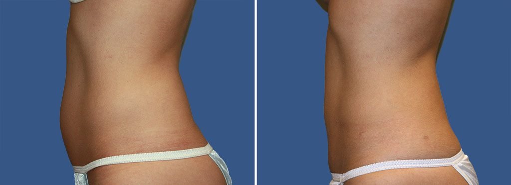 CoolSculpting® Patient 15