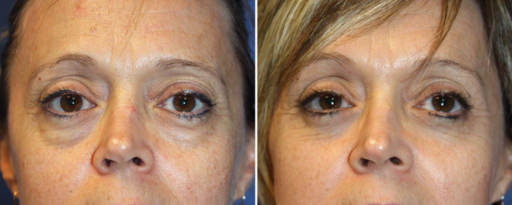 Eyelid Rejuvenation Patient 10