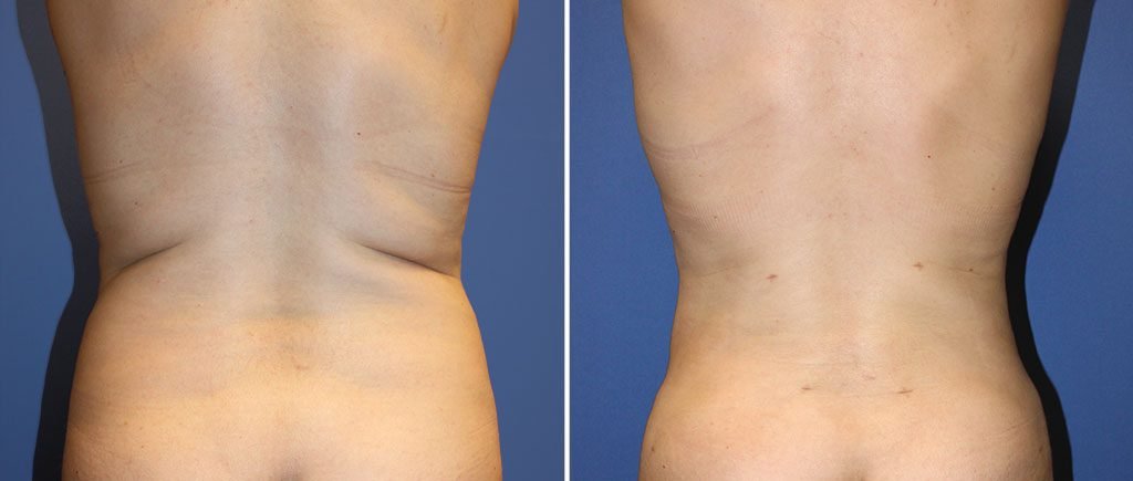 Liposuction Patient 9