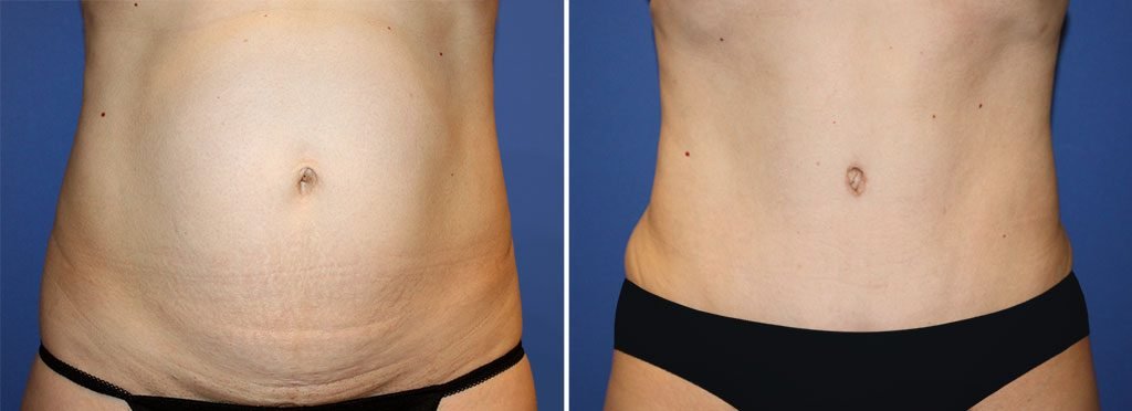 Tummy Tuck Patient 34