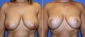 Breast Lift Patient 3