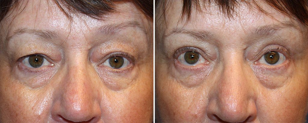 Eyelid Rejuvenation Patient 11