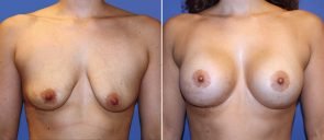Breast Augmentation with Lift Patient 21