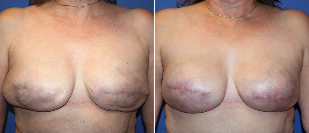 Breast Reconstruction Patient 3