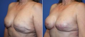breast-reconstruction-19378b-berks