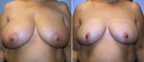 Breast Reduction Patient 22