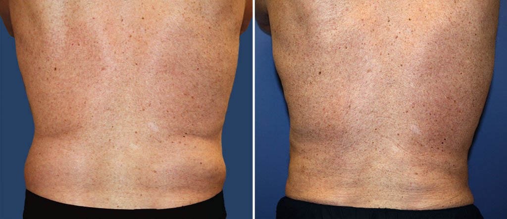 Male patient shown before and after liposuction