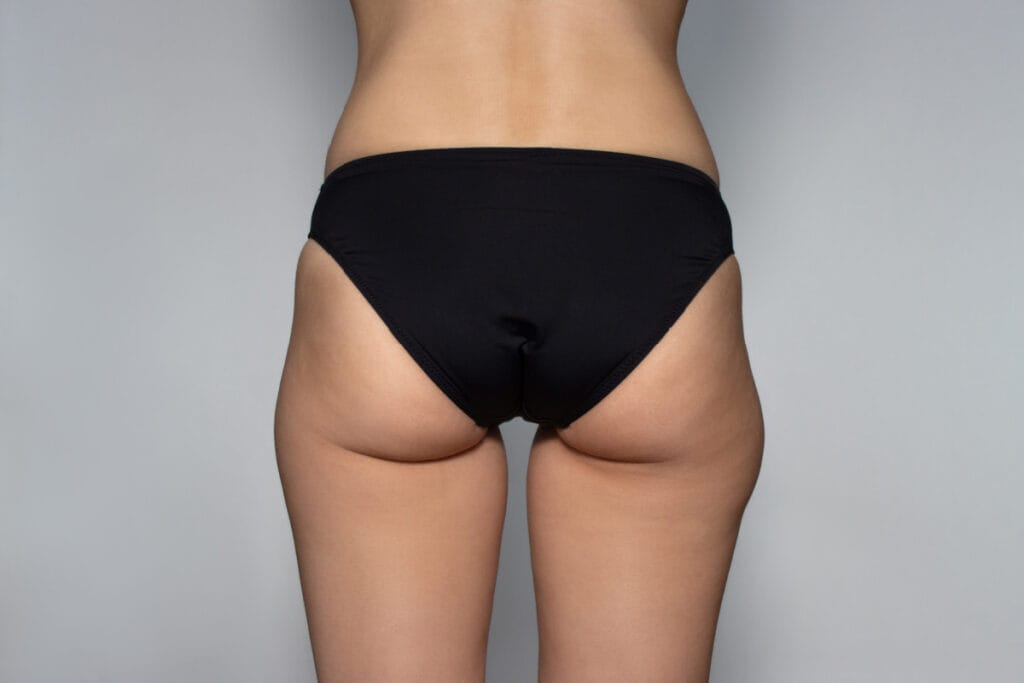 Back side of thin woman with saddlebags and excess fat on outer thighs