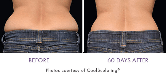 CoolSculpting before and after photos of a lower back patient